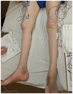 Use of Surface EMG in Clinical Rehabilitation of Individuals With SCI: Barriers and Future Considerations